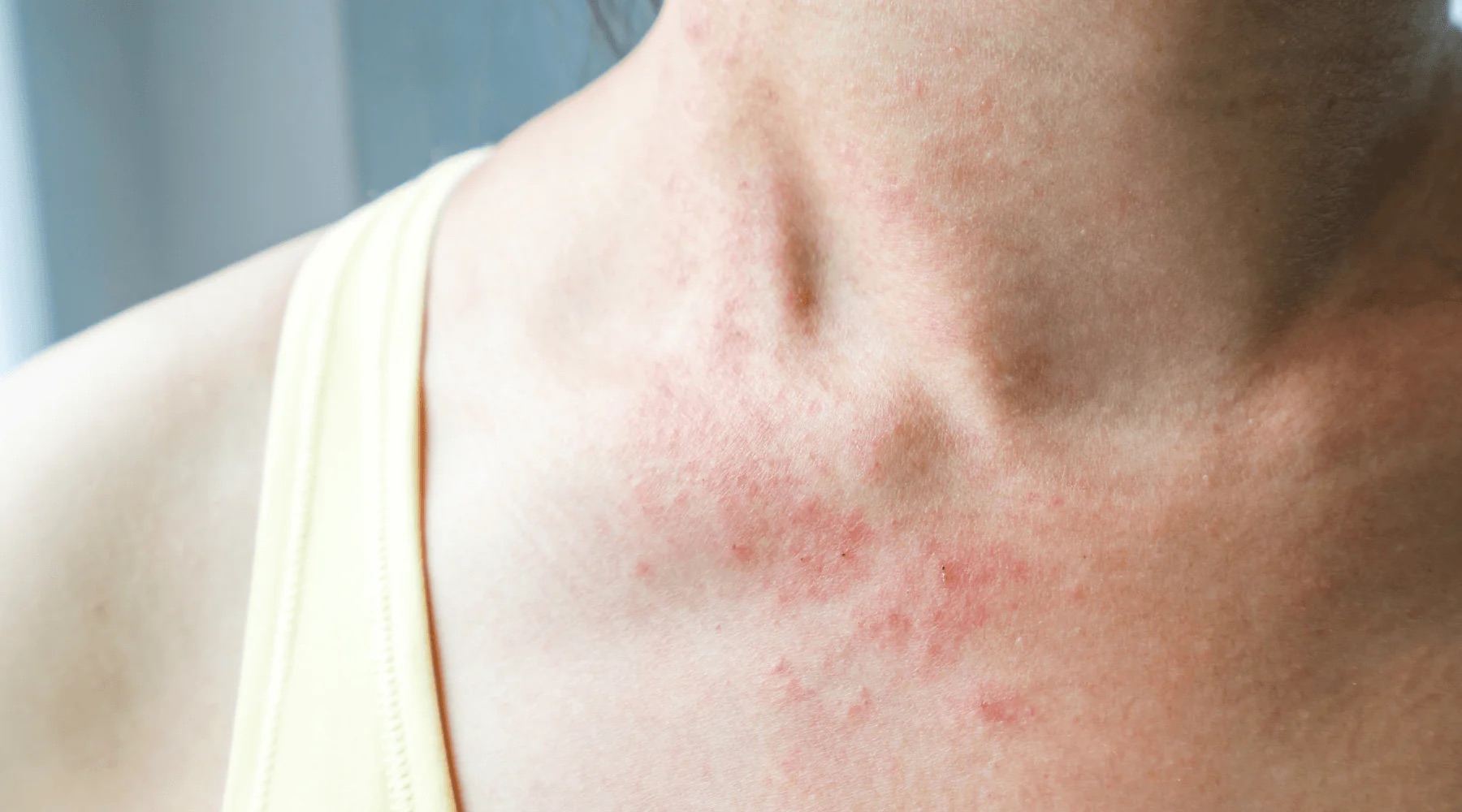 Histamin